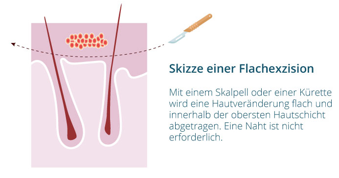 Flachexzision Flachexzision