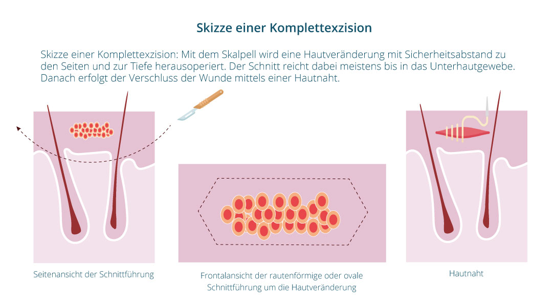 Komplettexzision Komplettexzision