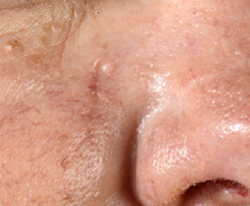 Befund Dehnungslappenplastik