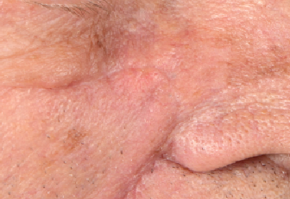 Verschiebelappenplastik